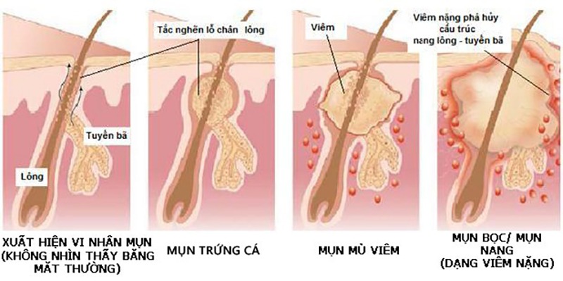 Có các loại mụn nào